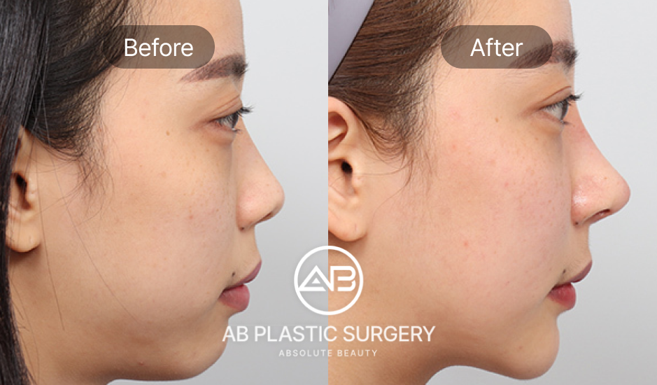 รูปภาพศัลยกรรมเสริมจมูกก่อนหลัง เกาหลีโรงพยาบาลศัลยกรรมAB