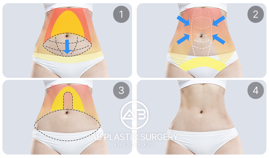 ภาพแสดงขั้นตอนการออกแบบและดูดไขมันหน้าท้องแบบเฉพาะจุด โดยโรงพยาบาลศัลยกรรมAB ประเทศเกาหลี