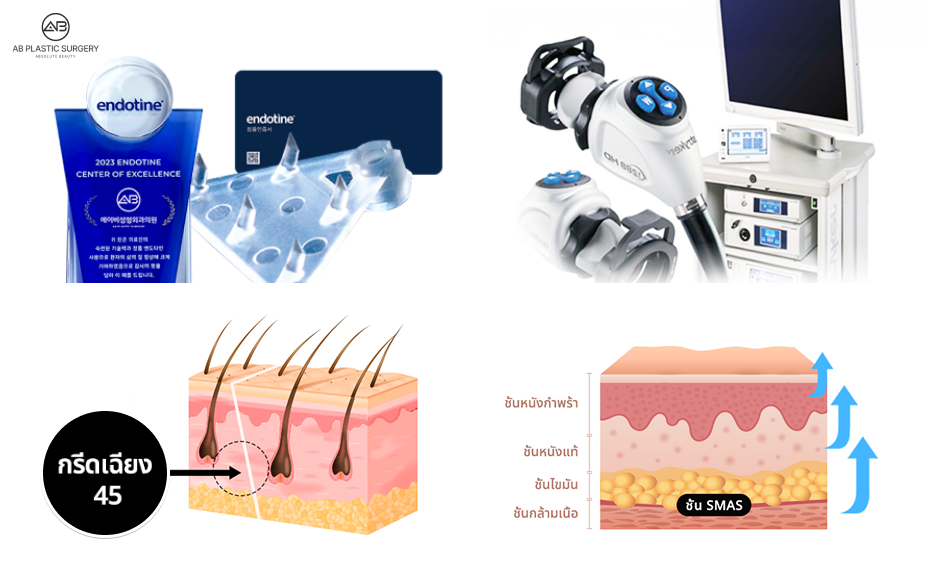 วัสดุเอนโดไทน์สำหรับยกคิ้วแบบละลายได้ พร้อมแสดงชั้นผิวและกล้องผ่าตัด FULL HD