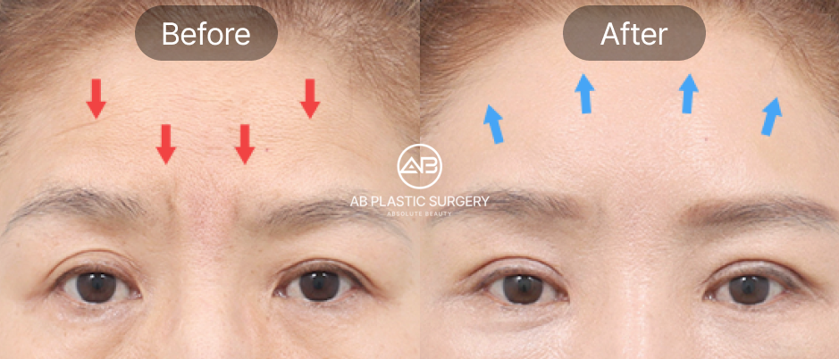 ก่อนหลังยกคิ้วเอนโดไทน์ ลดรอยย่นหน้าผากได้ชัดเจน