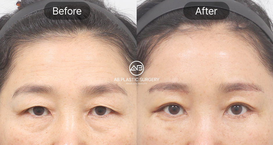 ก่อนหลังยกคิ้วเอนโดไทน์ ยกคิ้วชัดเจนโดยไม่ต้องผ่าตัดเปิดหน้าผาก