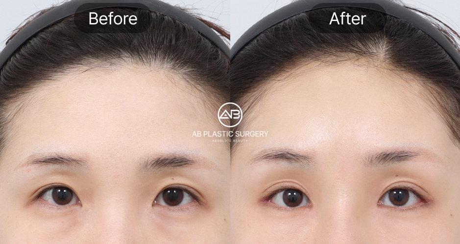 ก่อนหลังร้อยไหมยกคิ้ว เหมาะกับผู้ที่มีคิ้วตกเล็กน้อย