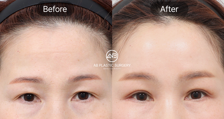 รีวิวก่อนหลังยกคิ้วเอนโดไทน์จากผู้ใช้บริการจริงที่เกาหลี