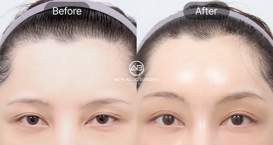 เอนโดไทน์ ยกคิ้ว ก่อนหลัง