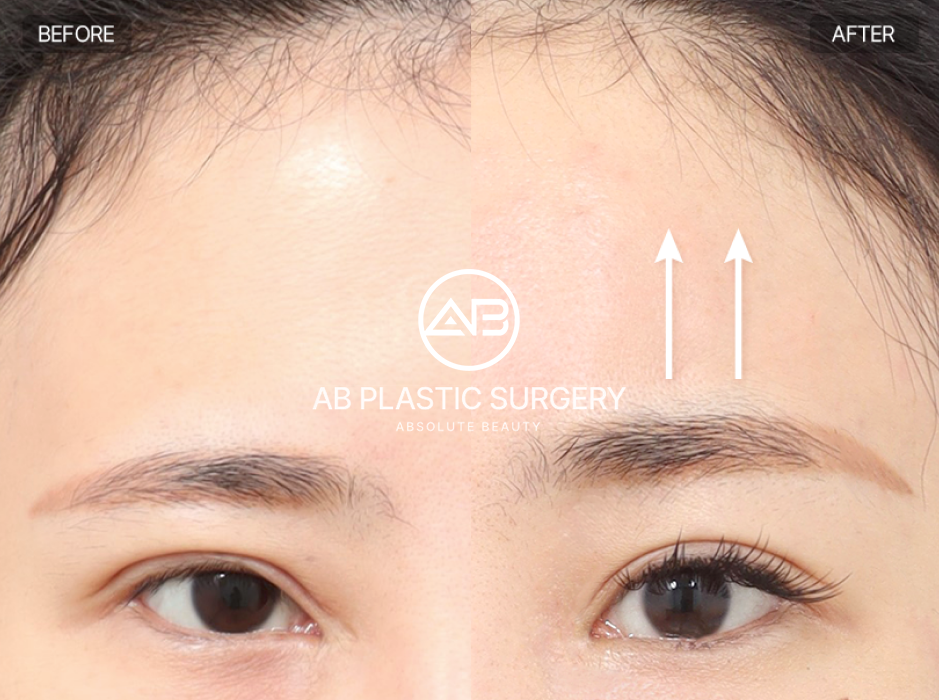 เอนโดไทน์ ยกคิ้ว ก่อนหลัง เหมาะกับคนคิ้วตก ชั้นตาหาย หนังตาหนัก