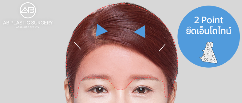 เอนโดไทน์ ตำแหน่งยึด 2 จุด