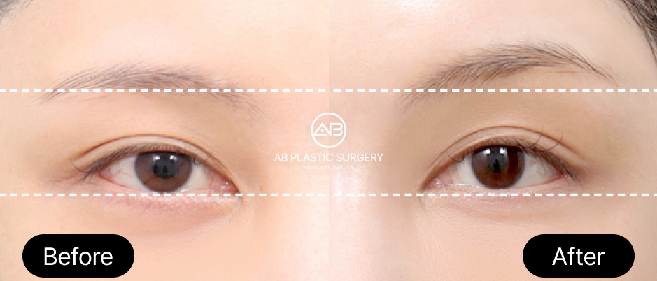 เอนโดไทน์ ยกคิ้ว ก่อนหลัง โรงพยาบาลศัลยกรรม AB เกาหลี