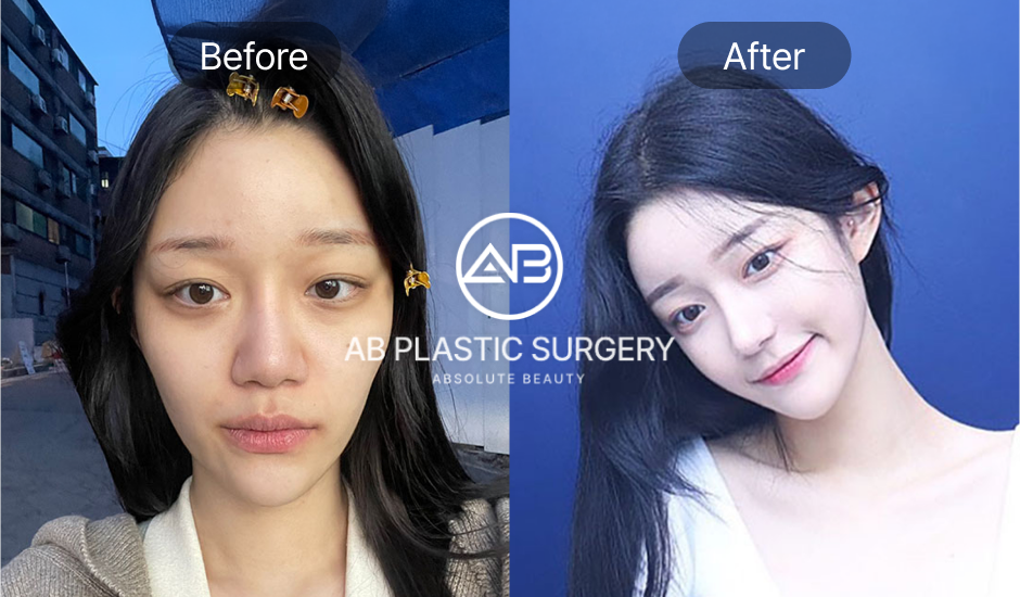 ภาพเปรียบเทียบก่อนและหลังศัลยกรรมโหนกแก้ม – จากโหนกแก้มเด่นชัดสู่ใบหน้าที่เรียวและละมุน