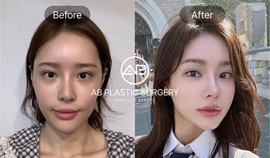 ภาพเปรียบเทียบก่อนและหลังศัลยกรรมโหนกแก้ม