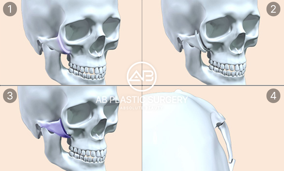 ภาพแสดงขั้นตอนการหมุนกระดูกและยึดโหนกแก้มแบบ 2 ชั้น ป้องกันแก้มหย่อน