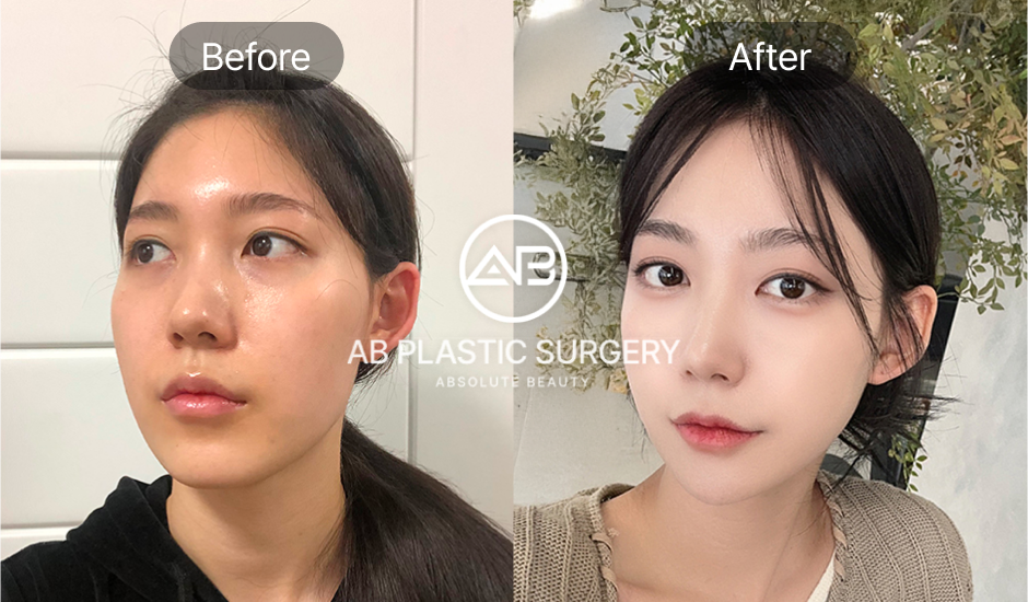 ภาพ Before & After หลังศัลยกรรมโหนกแก้มเพียงอย่างเดียว หน้าเรียวขึ้นอย่างเห็นได้ชัด