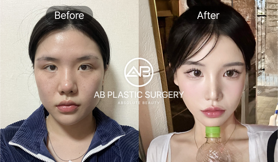 ภาพ Before & After หลังทำศัลยกรรมโหนกแก้ม กราม และคาง ปรับโครงหน้า 3 จุด