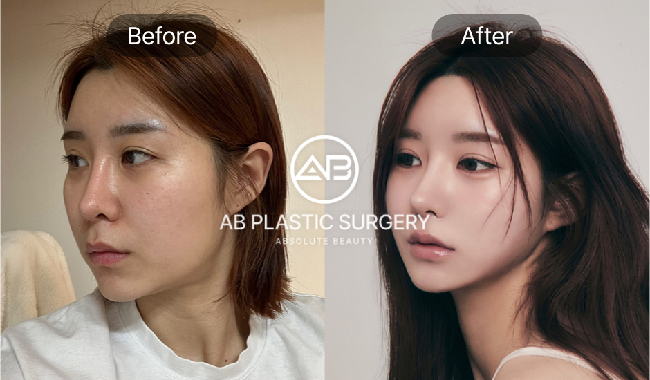 ภาพ Before & After มุม 45 องศา ลดโหนกแก้มด้านข้าง ปรับใบหน้าให้ดูละมุนขึ้น