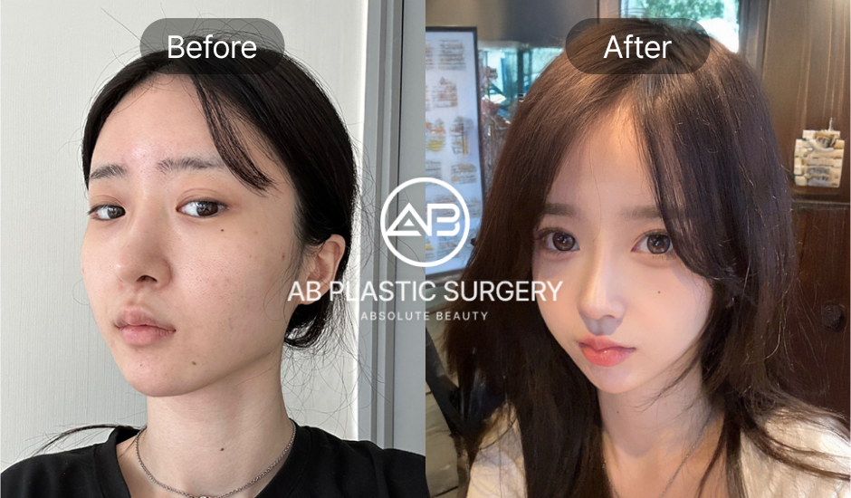 ภาพ Before & After ศัลยกรรมโหนกแก้มเคสจริงจาก AB ผลลัพธ์ธรรมชาติ ใบหน้าดูละมุน
