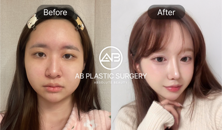 ก่อน-หลังศัลยกรรมปรับรูปหน้าที่โรงพยาบาลศัลยกรรมAB ประเทศเกาหลี