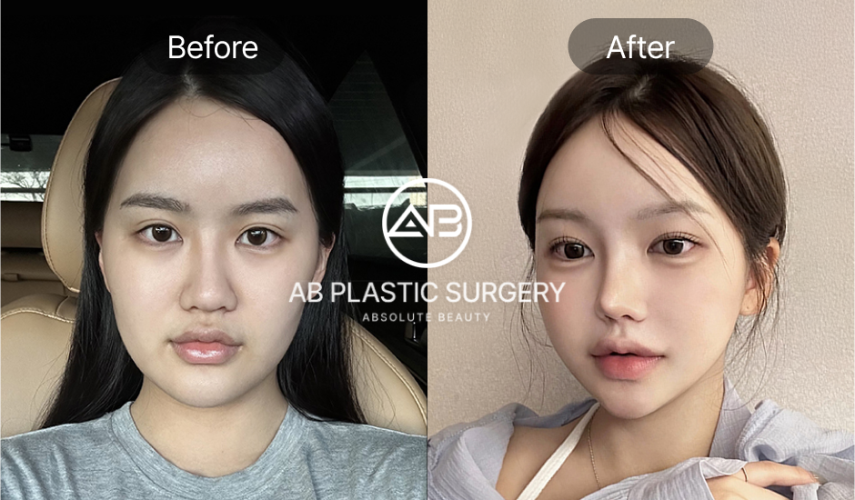 ภาพ Before & After ศัลยกรรมลดโหนกแก้ม กราม และคาง ปรับหน้าให้ได้รูป V-line