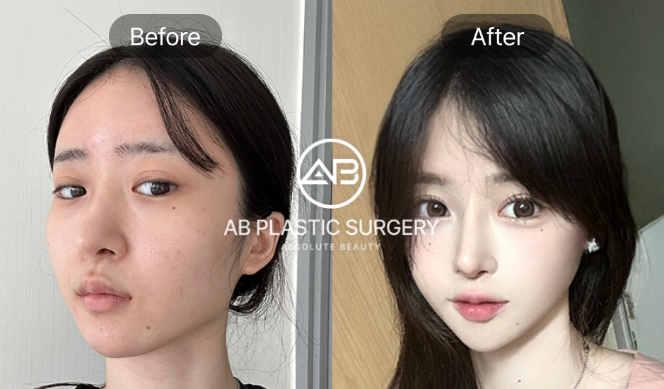 ภาพก่อน–หลังทำตาสองชั้นและเปิดหัวตาแบบเกาหลี