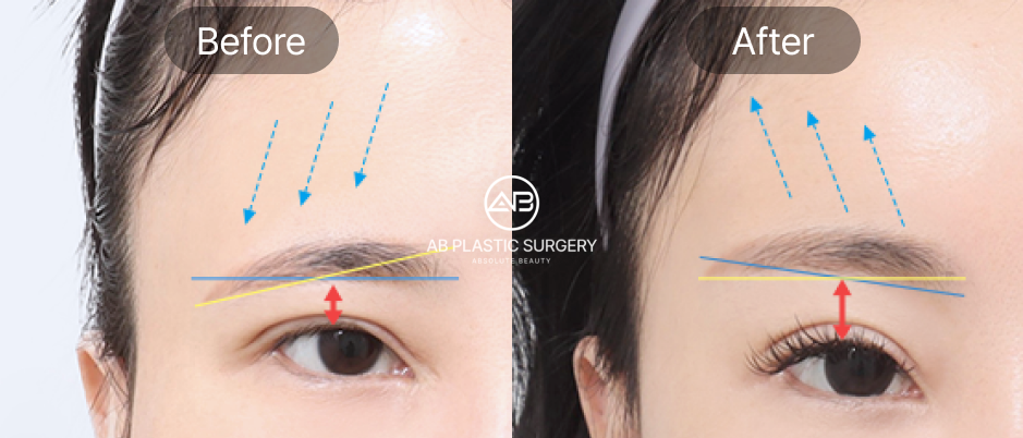 ภาพเปรียบเทียบก่อน–หลังการยกคิ้วด้วย Endotine
