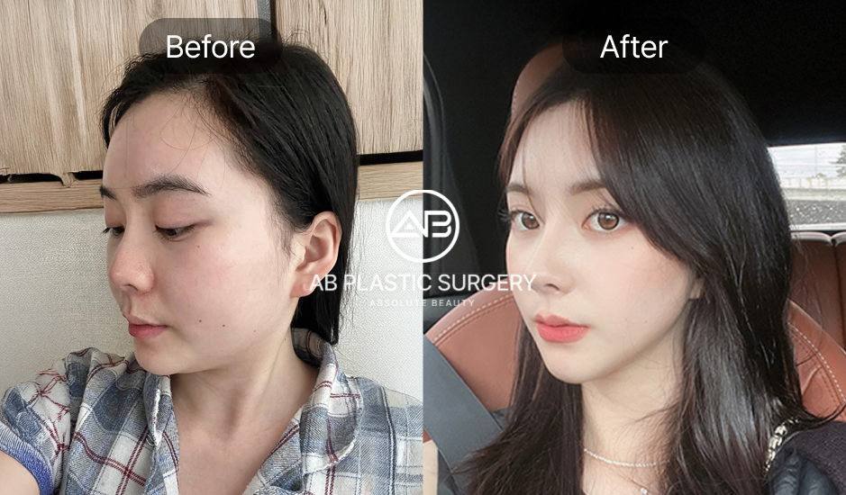 รูปรีวิวจากคนไข้จริง หลังเสริมจมูกครบ 1 เดือน 