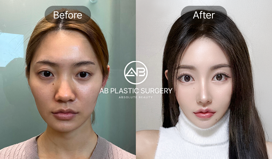 รูปรีวิวจากคนไข้จริง หลังเสริมจมูกครบ 3 เดือน 