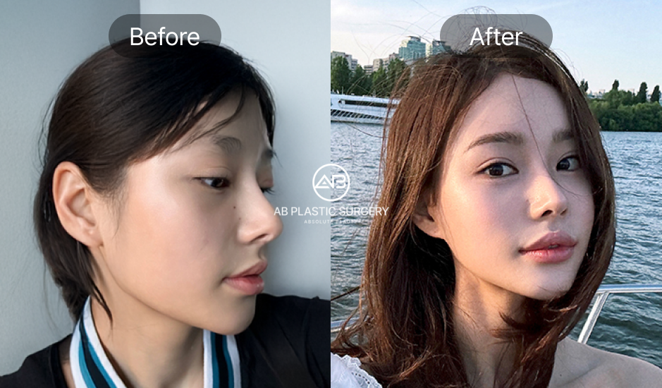 รูปรีวิวจากคนไข้จริง หลังเสริมจมูกครบ 9-11 เดือน 