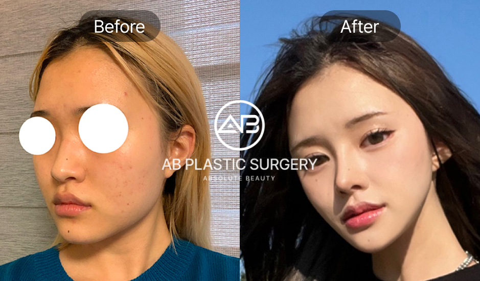 รูปรีวิวจากคนไข้จริง หลังเสริมจมูกครบ 1 ปี 