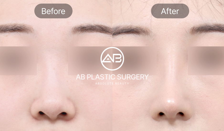  รูปก่อนและหลังเสริมจมูก จากมุมตรง