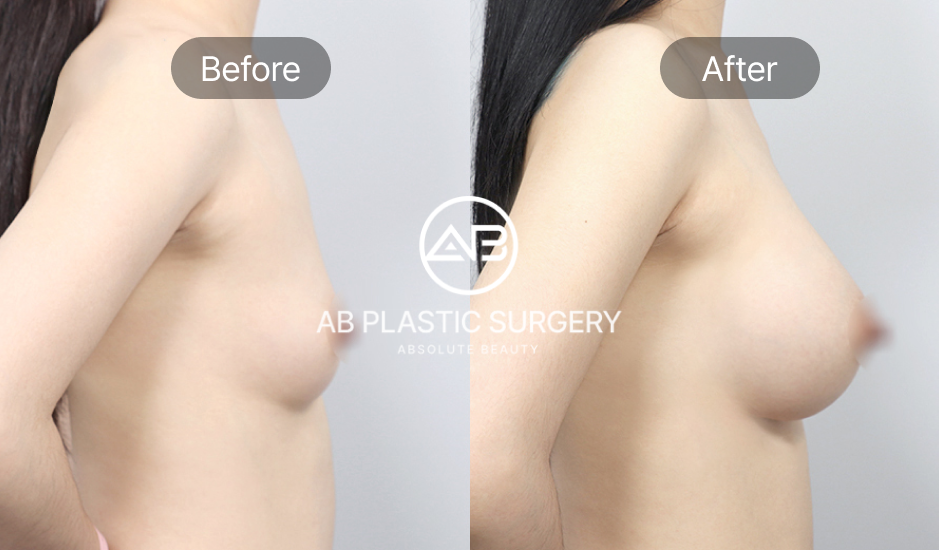 ภาพก่อนและหลังเสริมหน้าอกด้านข้าง แสดงผลลัพธ์ชัดเจนที่โรงพยาบาลศัลยกรรม AB เกาหลี