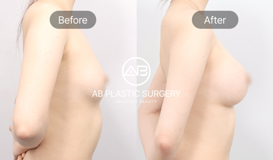 เปรียบเทียบภาพก่อนและหลังเสริมหน้าอก มุมด้านข้างของผู้เข้ารับบริการที่โรงพยาบาลศัลยกรรม AB ประเทศเกาหลี