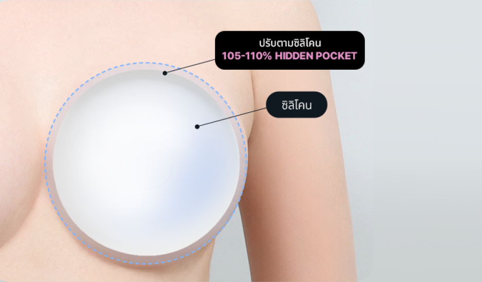 เทคนิค 105-110% Hidden Pocket สำหรับเสริมหน้าอก ซิลิโคนแนบสนิท ไม่เคลื่อน