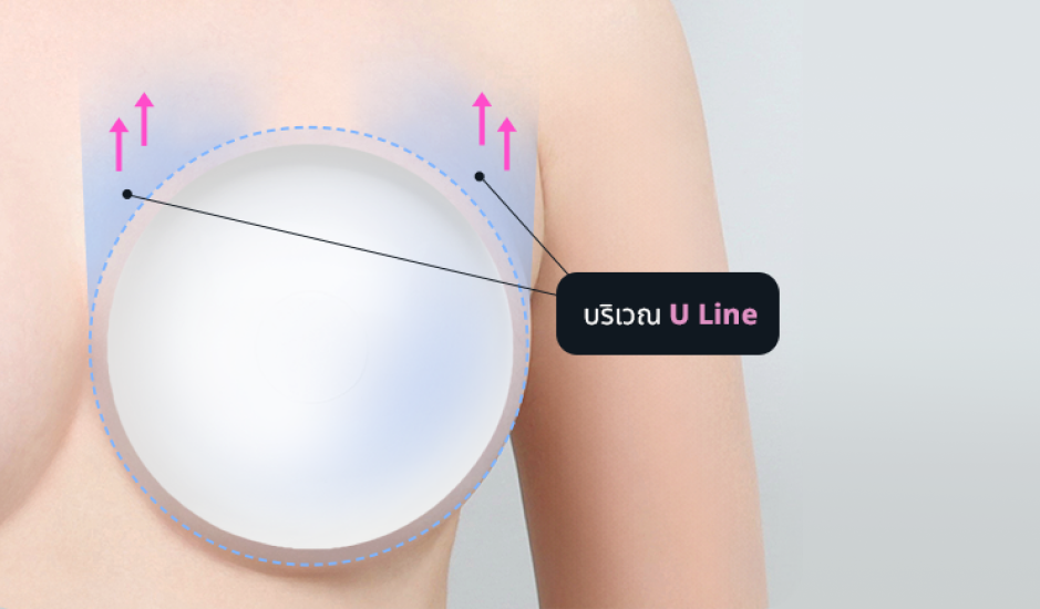เทคนิคเสริมหน้าอกให้มีทรง U Line โดยทีมแพทย์โรงพยาบาลศัลยกรรม AB ประเทศเกาหลี