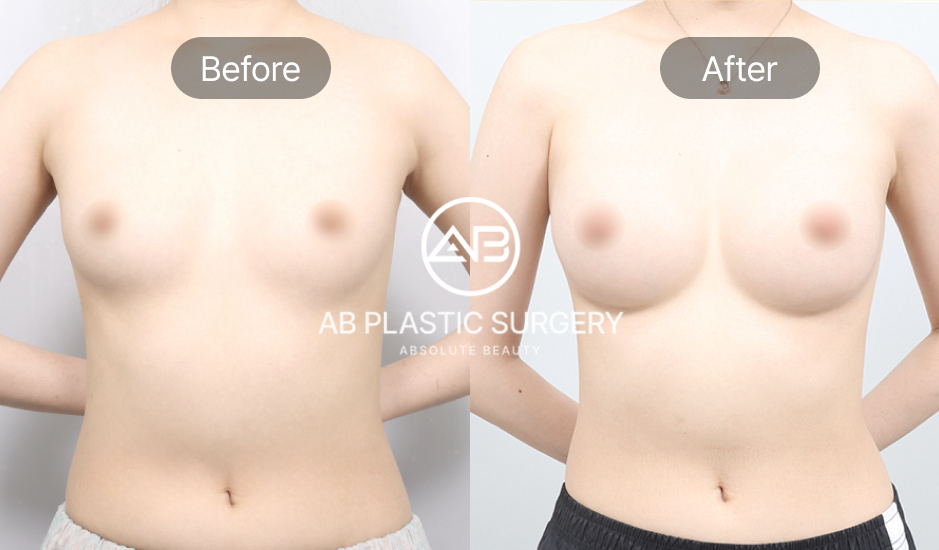 เปรียบเทียบภาพก่อนและหลังเสริมหน้าอกที่โรงพยาบาลศัลยกรรม AB ประเทศเกาหลี (มุมตรง)