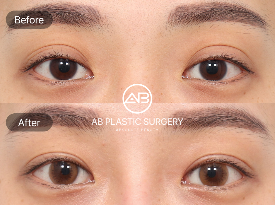 ภาพก่อนหลังศัลยกรรมแก้ตาปรือ ที่เกาหลีโรงพยาบาลศัลยกรรมAB ดวงตาดูกลมโตและสดใสขึ้น ผลลัพธ์เป็นธรรมชาติ