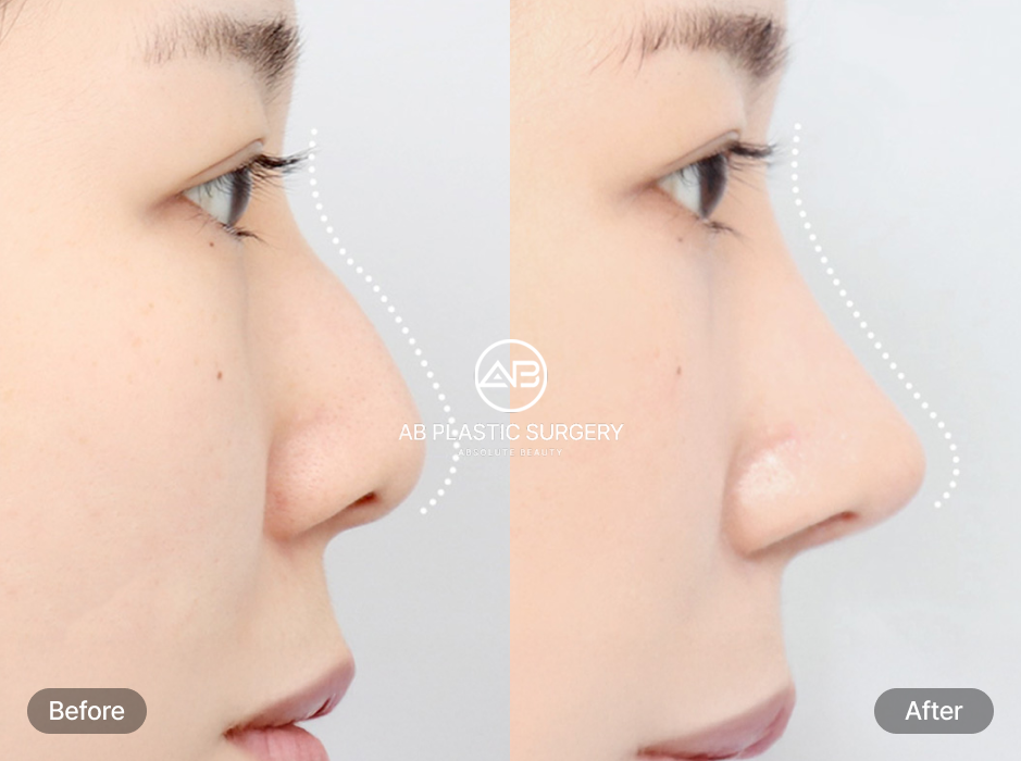 รีวิวศัลยกรรมจมูก โรงพยาบาลศัลยกรรมABประเทศเกาหลี ด้านซ้ายก่อนเหลาฮัมพ์จมูก ด้านขวาหลังผ่าตัด 7 เดือนจมูกเรียบเนียนเข้ากับใบหน้า