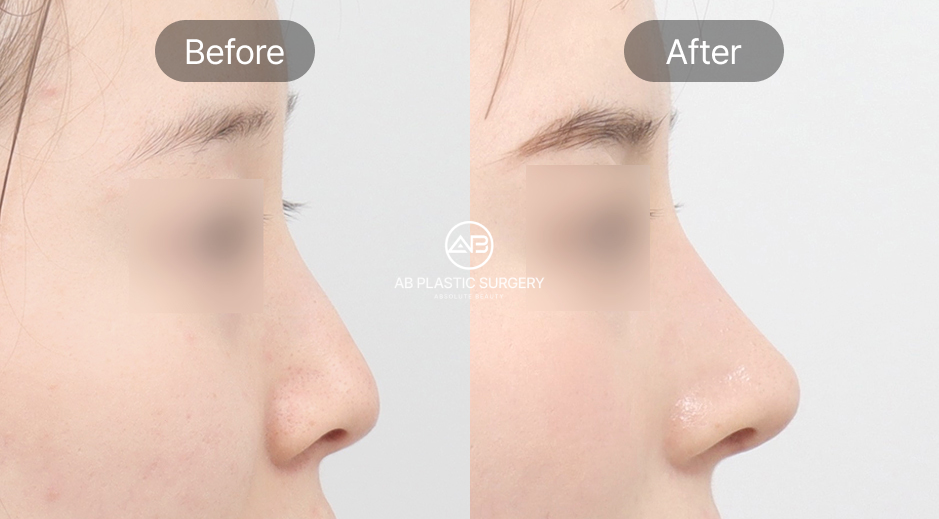 ภาพรีวิวศัลยกรรมจมูก ก่อน–หลัง เหลาฮัมพ์ที่โรงพยาบาลศัลยกรรม AB ประเทศเกาหลี ด้านซ้ายก่อนเหลาฮัมพ์จมูก ด้านขวาหลังผ่าตัดจมูกเรียบเนียนและสมดุลกับใบหน้า