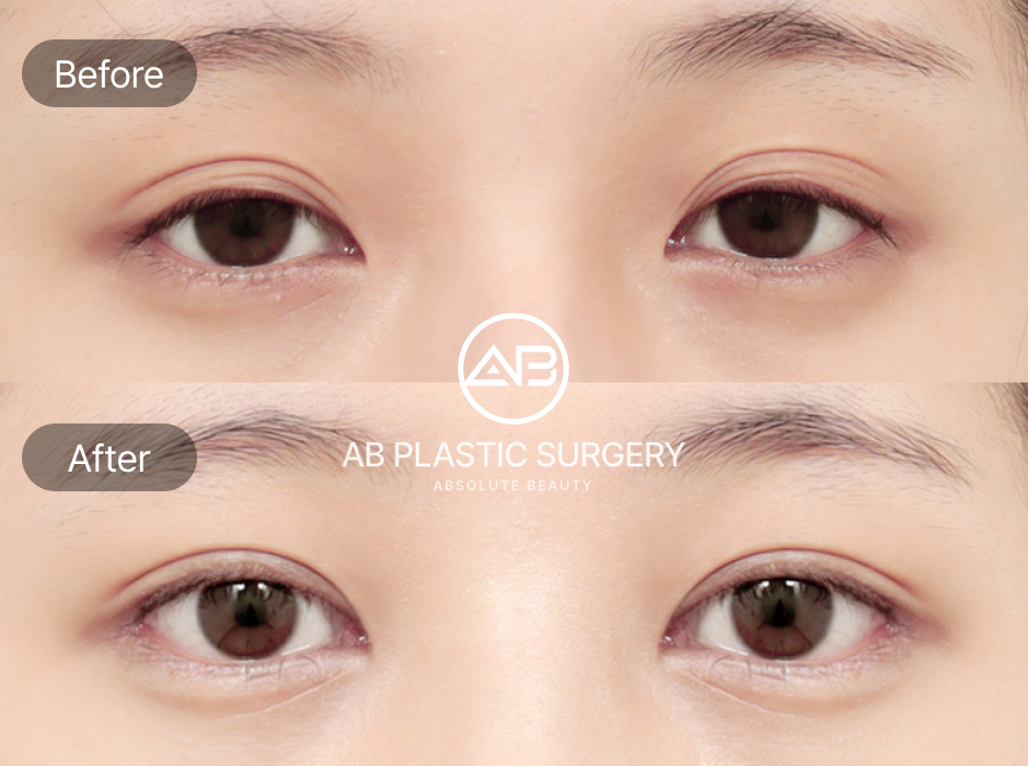 ภาพก่อนหลังศัลยกรรมแก้ตาปรือ โรงพยาบาลศัลยกรรมAB เกาหลี ดวงตาดูกลมโตและสดใสขึ้น ผลลัพธ์ชัดเจนและเป็นธรรมชาติ