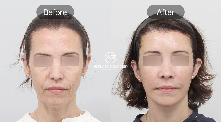 ภาพก่อน–หลังของผู้หญิงวัยกลางคน หลังทำการดึงหน้าแบบ SMAS ที่เกาหลีโรงพยาบาลศัลยกรรมAB เห็นการเปลี่ยนแปลง ใบหน้าดูกระชับขึ้นและริ้วรอยลดลงชัดเจน เป็นตัวอย่างรีวิวผลลัพธ์จริง