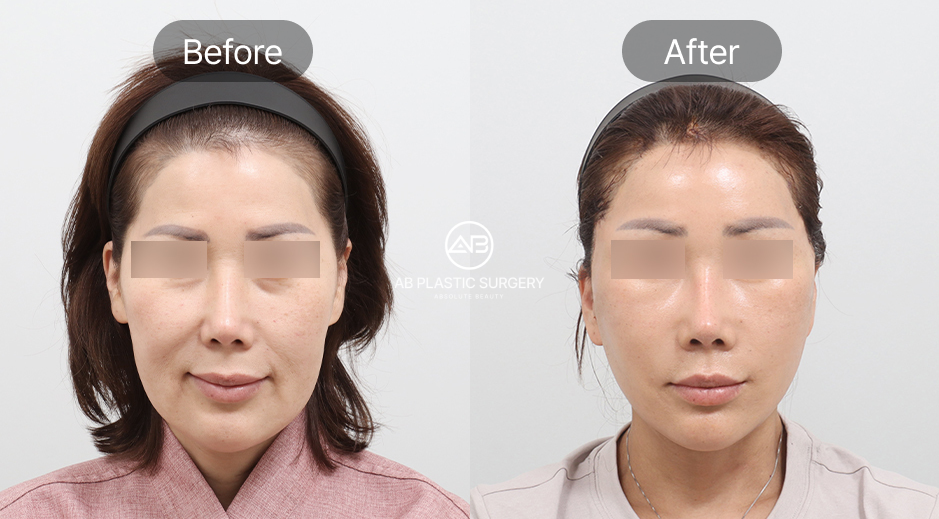 ภาพก่อน–หลังของผู้หญิง หลังทำการดึงหน้าแบบ SMAS ที่เกาหลีโรงพยาบาลศัลยกรรมAB เห็นการเปลี่ยนแปลง ใบหน้าดูกระชับและเรียวขึ้น ผลลัพธ์ชัดเจนและเป็นธรรมชาติ
