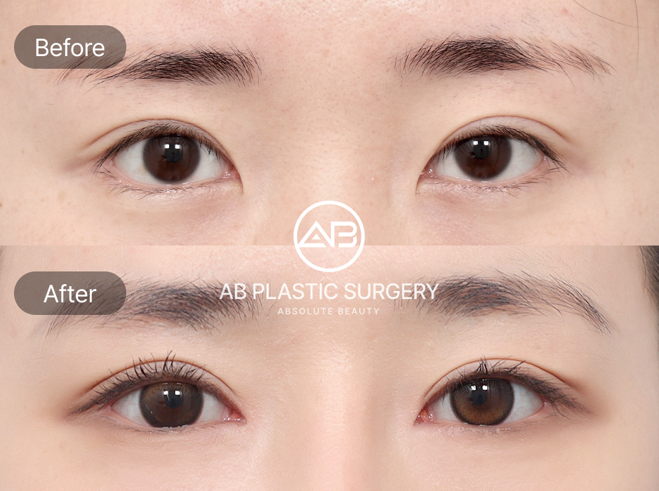 ภาพก่อนหลังศัลยกรรมแก้ตาปรือ โรงพยาบาลศัลยกรรมAB เกาหลี ผลลัพธ์หลังผ่าตัดทำให้ดวงตากลมโต เปิดกว้างและสดใสขึ้น