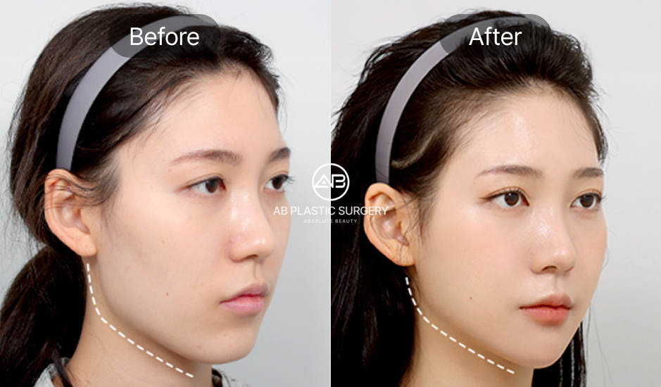 ภาพก่อน–หลังการตัดกราม ปรับโครงหน้าให้เรียวเล็กและสมส่วน  รีวิวจริงจากโรงพยาบาลศัลยกรรม AB ประเทศเกาหลี