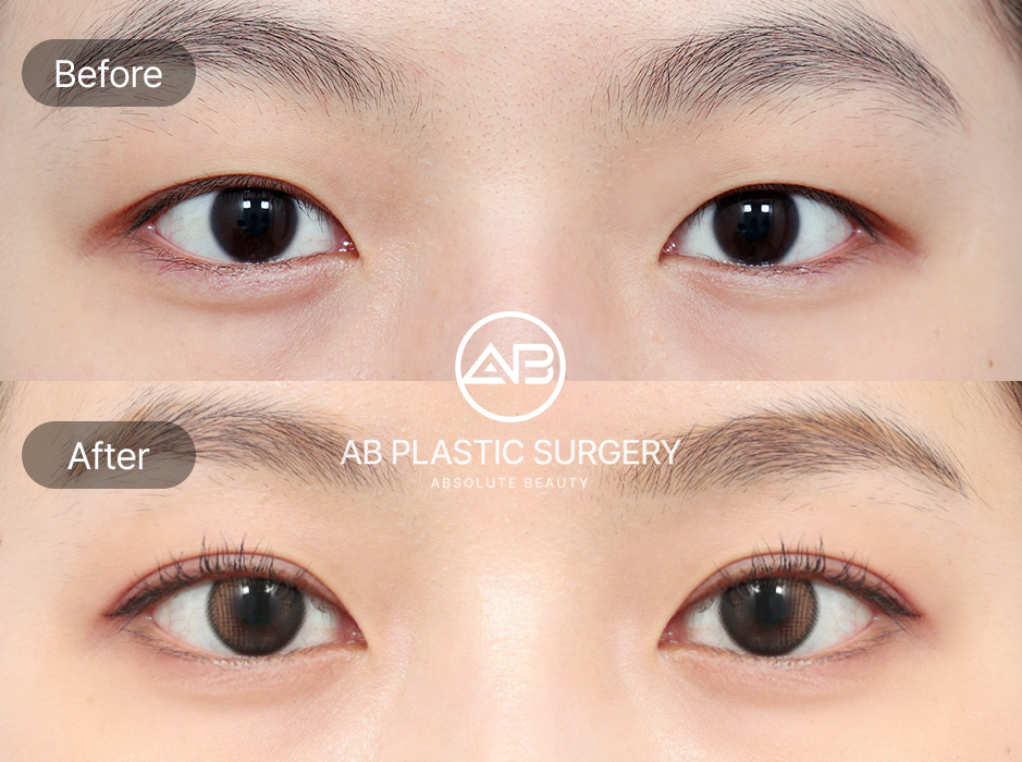 ภาพก่อนหลังการแก้ตาปรือ โรงพยาบาลศัลยกรรมAB เกาหลี ดวงตาหลังผ่าตัดดูกลมโต เปิดกว้างและสดใสขึ้น