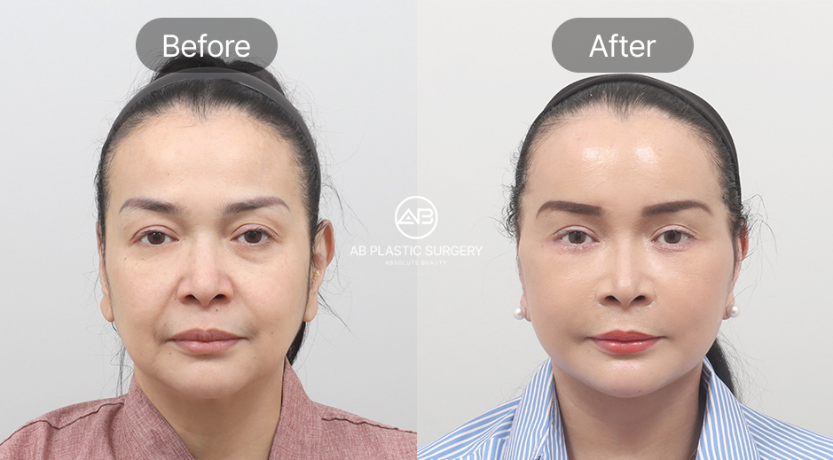 ภาพก่อน–หลังของผู้หญิง หลังทำการดึงหน้าแบบ SMAS ที่เกาหลีโรงพยาบาลศัลยกรรมAB ใบหน้าดูกระชับและอ่อนเยาว์ขึ้น รีวิวผลลัพธ์จริงจากอินฟลูเอนเซอร์อินโดนีเซีย Jennifer Jill Armand Supit