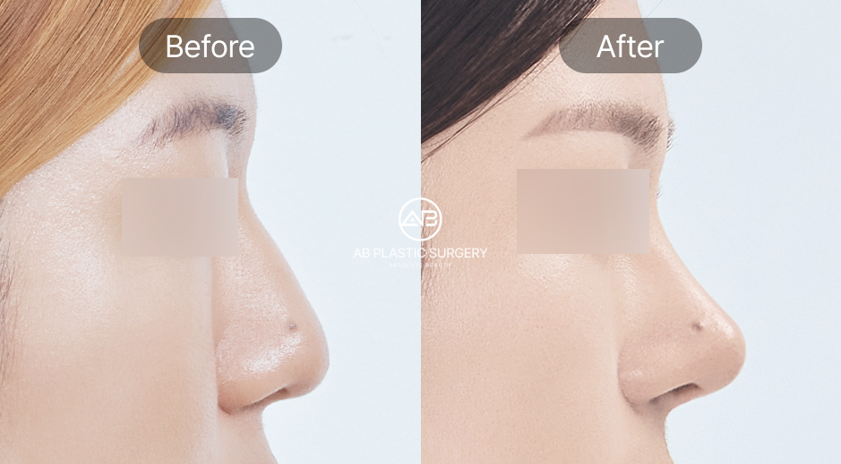 ภาพรีวิวศัลยกรรมจมูก ก่อน–หลัง เหลาฮัมพ์ที่โรงพยาบาลศัลยกรรม AB ประเทศเกาหลี ด้านซ้ายก่อนเหลาฮัมพ์จมูก ด้านขวาหลังผ่าตัดจมูกเรียบเนียนและสมดุลกับใบหน้า