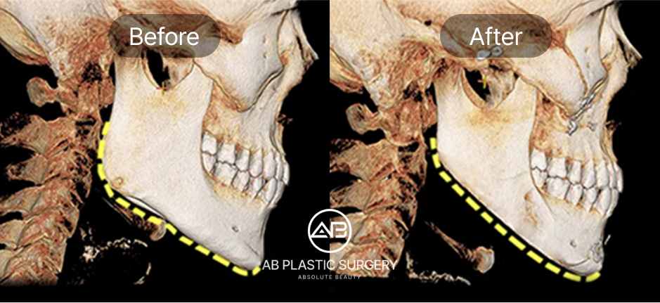 ภาพ CT สแกนก่อน–หลังการตัดกรามวีไลน์ แสดงการปรับกรามและคางให้เรียวยาวเป็น V Line  ด้วยเทคนิคศัลยกรรมโครงหน้าที่โรงพยาบาลศัลยกรรม AB ประเทศเกาหลี