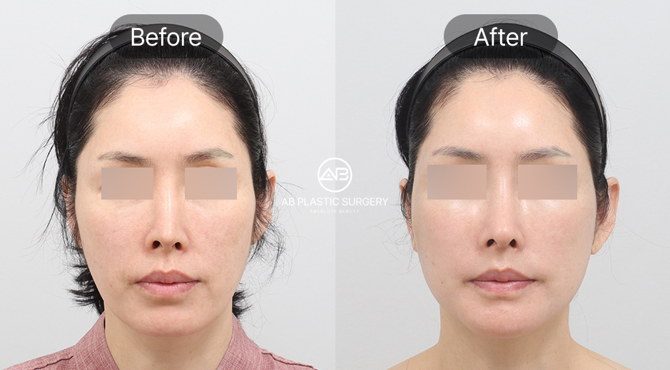 ภาพก่อน–หลังของผู้หญิง หลังทำการดึงหน้าแบบ SMAS ที่เกาหลีโรงพยาบาลศัลยกรรมAB ใบหน้าดูกระชับ ริ้วรอยลดลง และกรอบหน้าชัดเจนขึ้น
