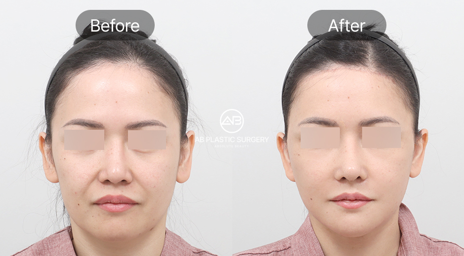 ภาพก่อน–หลังของผู้หญิง หลังทำการดึงหน้าแบบ SMAS ที่เกาหลีโรงพยาบาลศัลยกรรมAB เห็นผลลัพธ์ ใบหน้าดูกระชับ ร่องแก้มลดลง และผิวดูอ่อนเยาว์ขึ้น