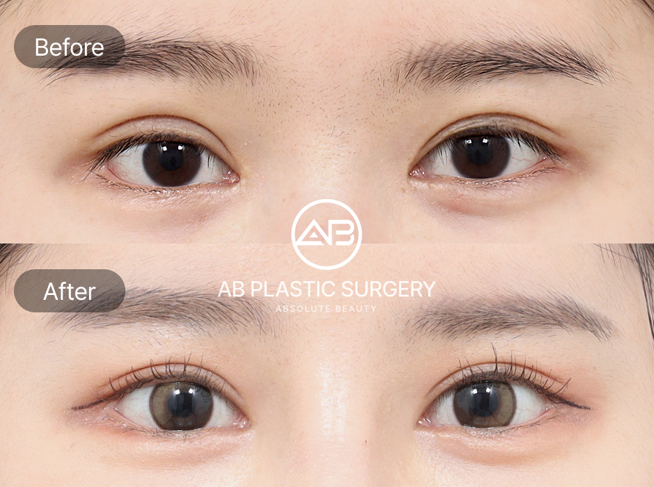 ภาพก่อนหลังศัลยกรรมแก้ตาปรือ โรงพยาบาลศัลยกรรมAB เกาหลี ดวงตาหลังผ่าตัดดูกลมโต เปิดกว้าง และผลลัพธ์เป็นธรรมชาติ