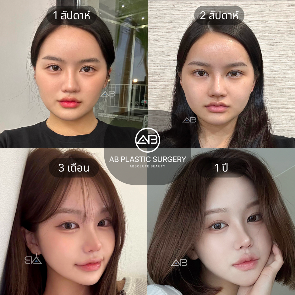 รีวิวก่อน–หลังตัดกราม ตั้งแต่ 1 สัปดาห์ ถึง 1 ปี แสดงการพักฟื้นและการเปลี่ยนแปลงโครงหน้าอย่างต่อเนื้อง  ที่โรงพยาบาล AB ประเทศเกาหลี