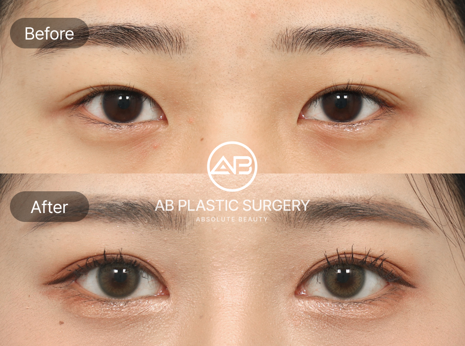 ภาพก่อนหลังการแก้ตาปรือ โรงพยาบาลศัลยกรรมAB เกาหลี หลังการผ่าตัดดวงตาดูโต สดใส และผลลัพธ์ชัดเจนกว่าเทคนิคไม่ผ่าตัด