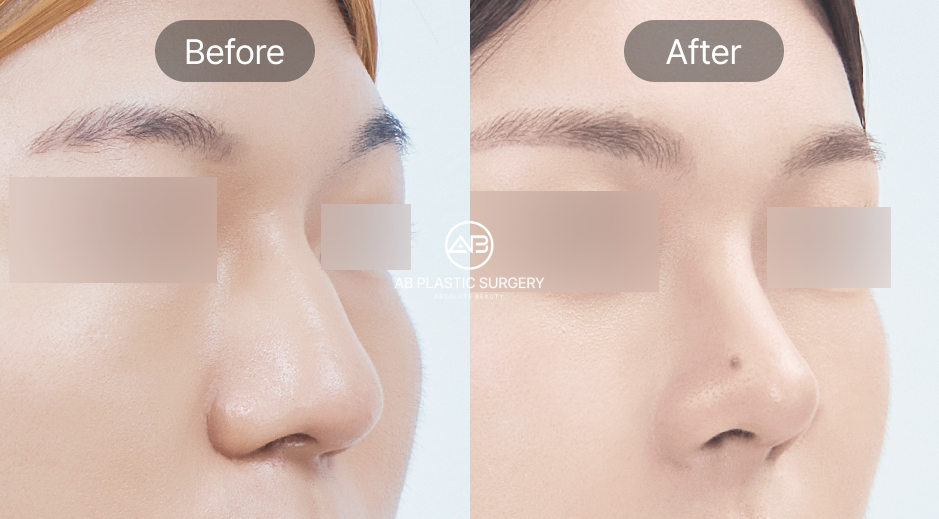 รูปก่อนและหลังการศัลยกรรมเหลาฮัมพ์